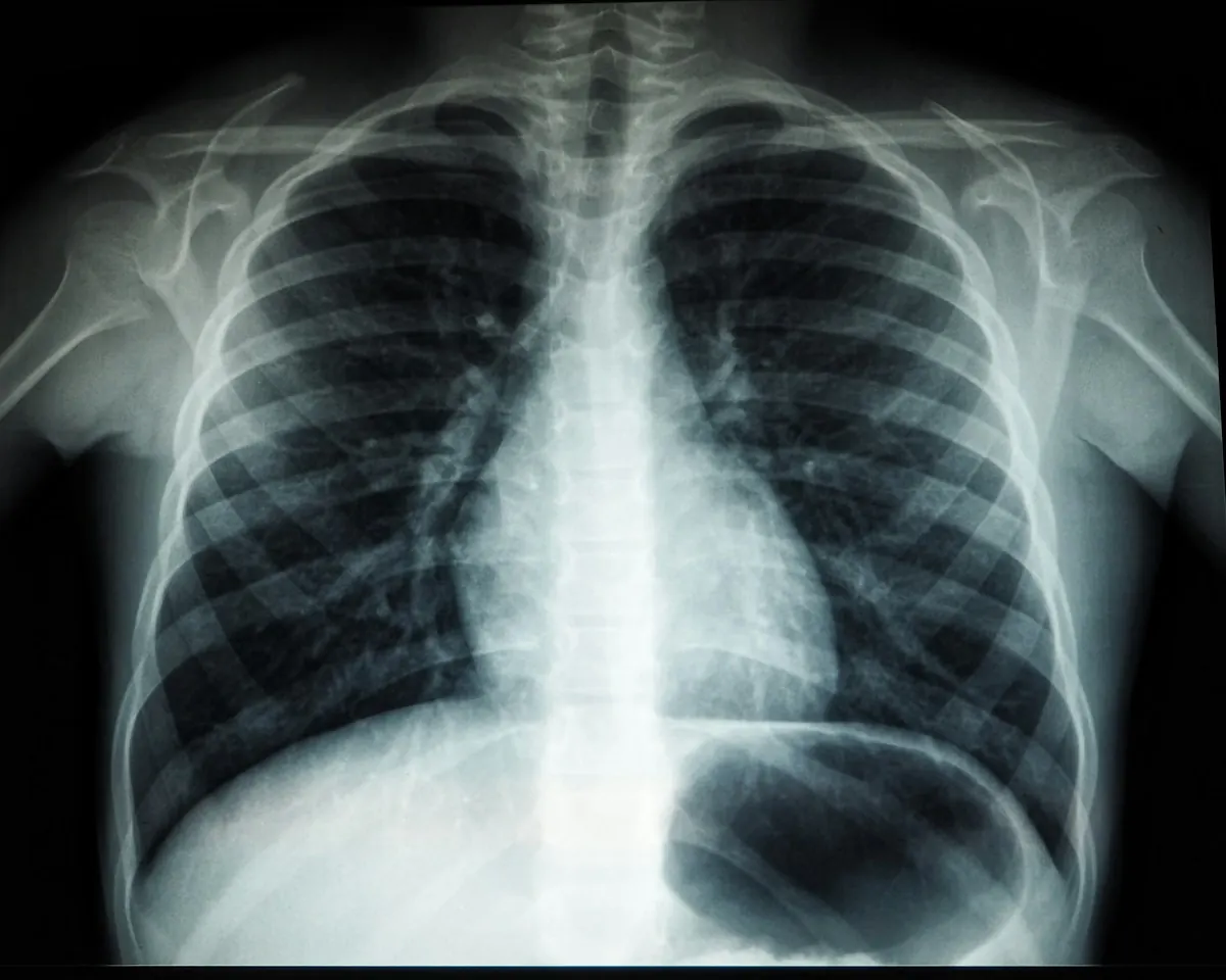 Radiografía de tórax que muestra los pulmones y la caja torácica